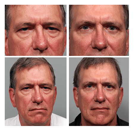 upper and lower transconj blepharoplasty