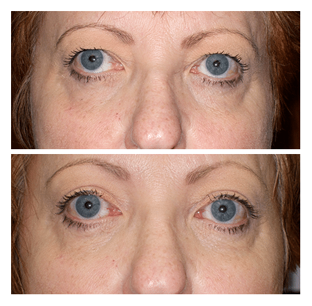 upper blepharoplasty and endoscopic browlift upper blepharoplasty and endoscopic browlift