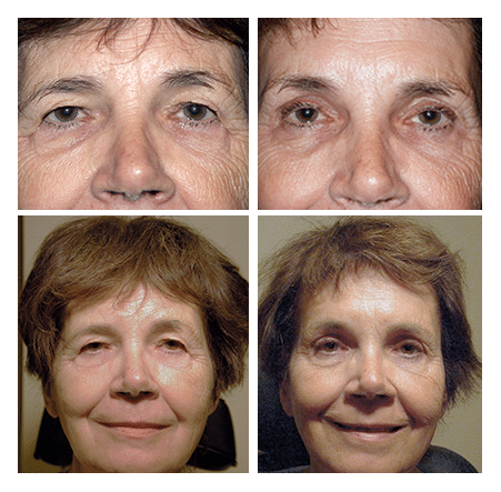 Upper blepharoplasty and endoscopic browlift