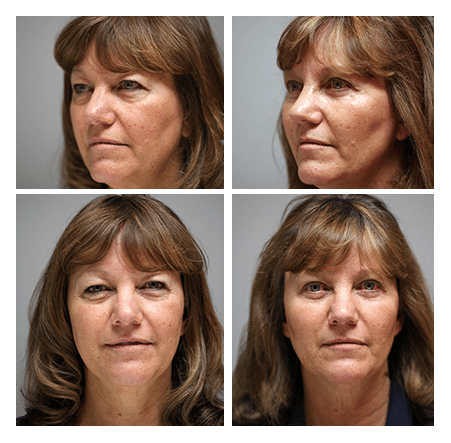 mid facelift, upper and lower extended