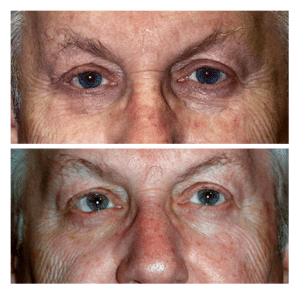 temp-1-eyelid-lesion
