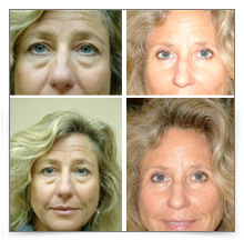 Upper & Lower Blepharoplasty