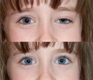 eyelid ptosis surgery denver droopy eyelid boulder co ptosis surgery