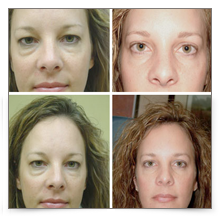 Upper & Lower Blepharoplasty
