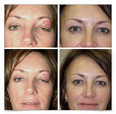 Thyroid Eye Disease (Graves')