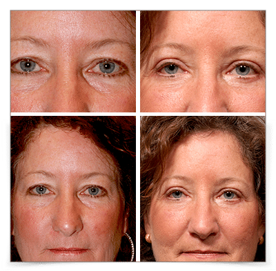 Upper & Lower Blepharoplasty