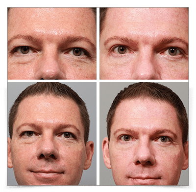 Upper & Lower Blepharoplasty