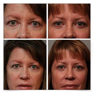 Upper and Lower Blepharoplasty