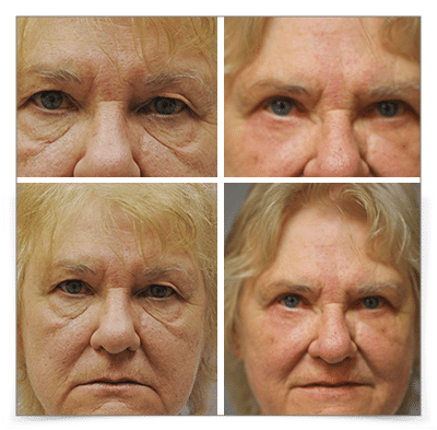 Upper and Lower Blepharoplasty
