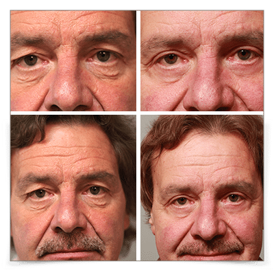 Upper and Lower Blepharoplasty