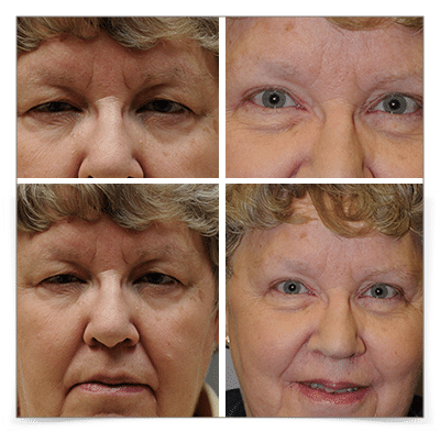 Upper Blepharoplasty and Ptosis