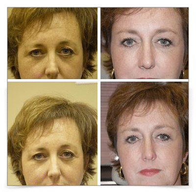Endoscopic Brow Lift