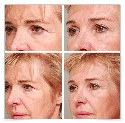 Endoscopic Forehead and Cheek Lifts