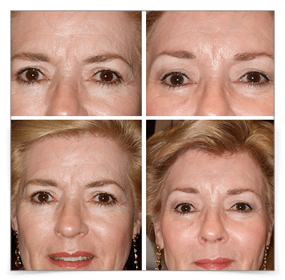 Endoscopic Mid-Facelift