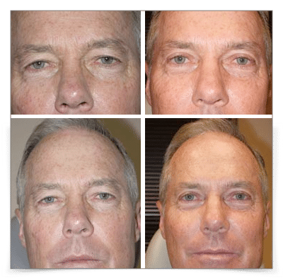 Upper Blepharoplasty
