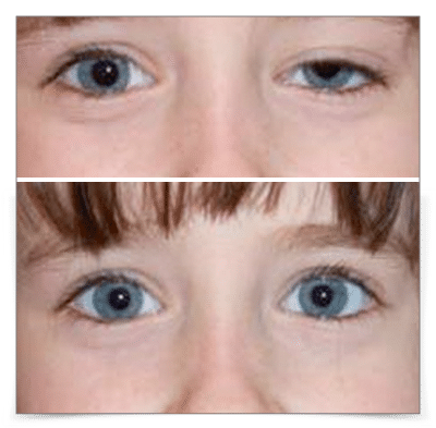 Eyelid Ptosis