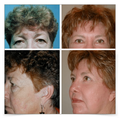 Eyelid & Face and Neck Lift