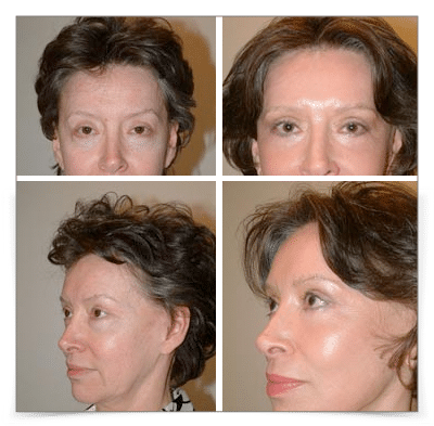 Eyelid & Face and Neck Lift