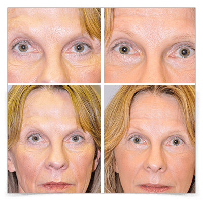 Jowl and Neck Lift