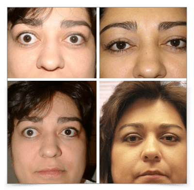 Thyroid Eye Disease (Graves')