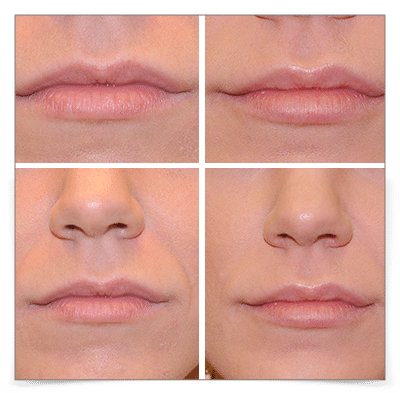 Lip Filler for Shape