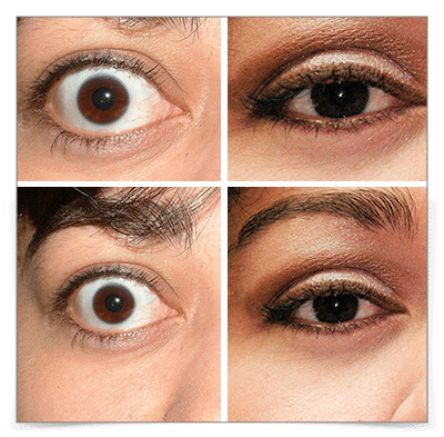 Thyroid Eye Disease (Graves')