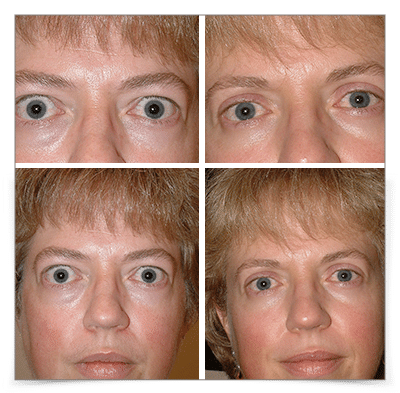 Thyroid Eye Disease (Graves')