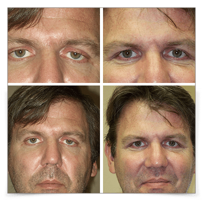 Eyelid Ptosis