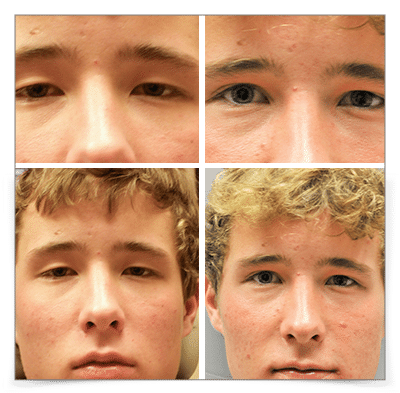 Eyelid Ptosis