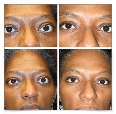 Thyroid Eye Disease (Graves')