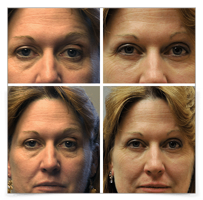 Upper & Lower Blepharoplasty