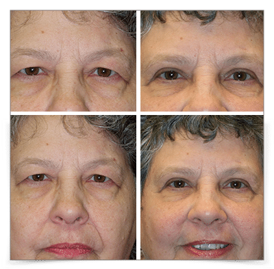 Upper and Lower Blepharoplasty