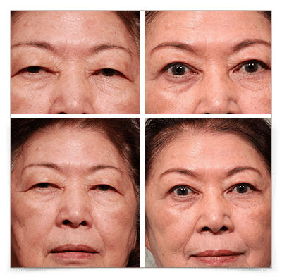Upper Blepharoplasty
