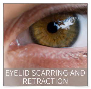eyelid scarring and retraction denver eyelid scarring and retraction denver