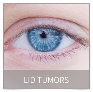 lid tumors denver lid tumors denver