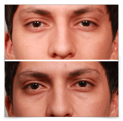 Otoplasty