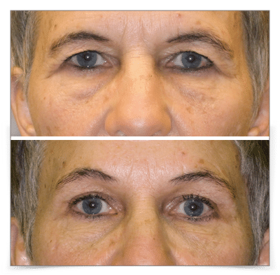 Endoscopic Brow Lift and Upper Blepharoplasty