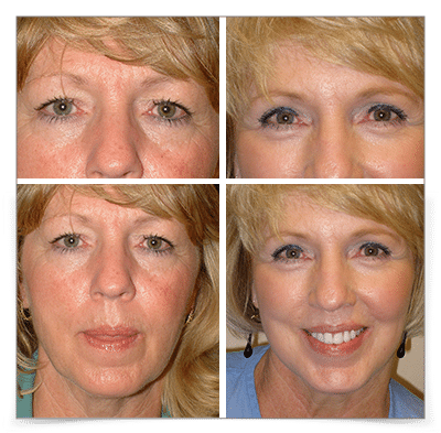 Eyelid and Face Lift