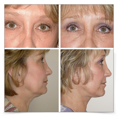  Eyelid and Face Lift