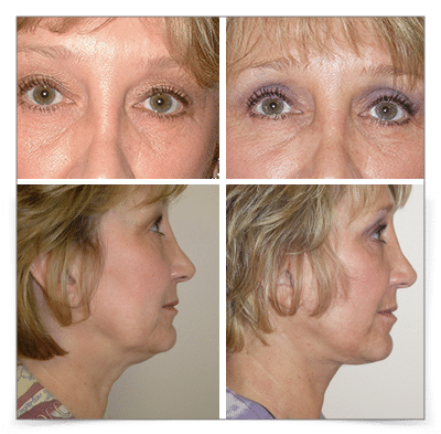 Eyelid and Face Lift