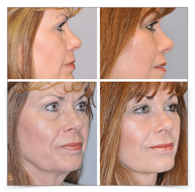 Eyelid and Face Lift