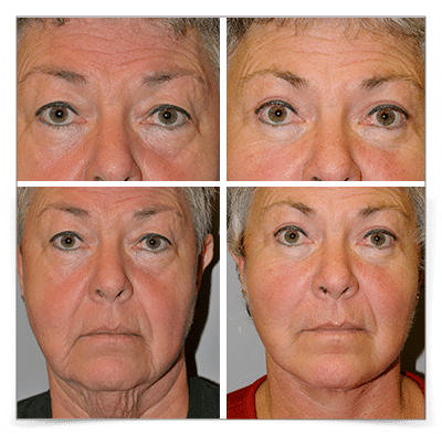 Eyelid & Face and Neck Lift