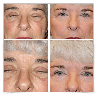 Eyelid Ptosis
