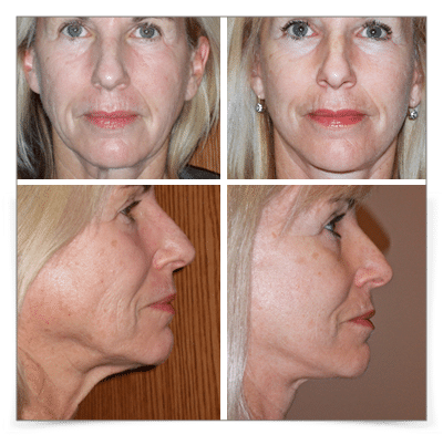 Neck Lift