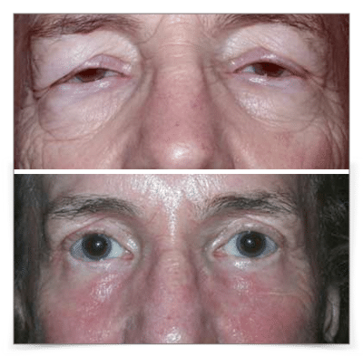 Laser Resurfacing