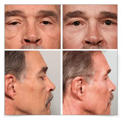 Eyelid Ptosis and Blepharoplasty