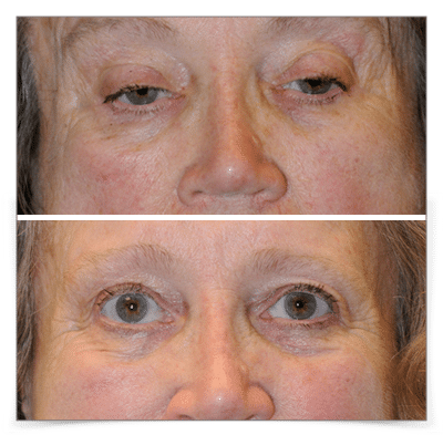 Ptosis Repair