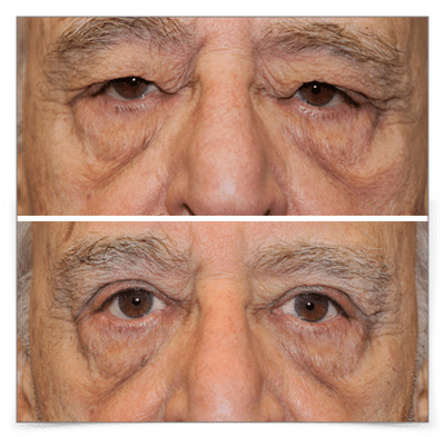 Upper Blepharoplasty