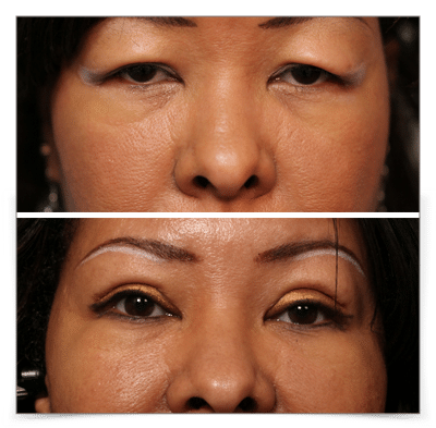 Upper Blepharoplasty & Ptosis Repair