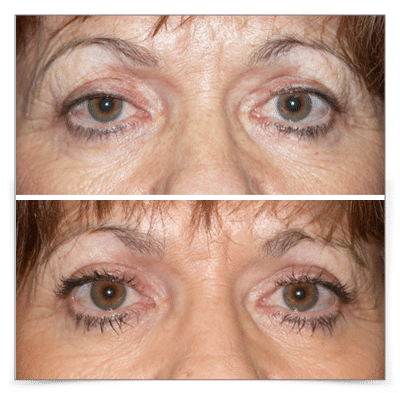Right Ptosis Repair